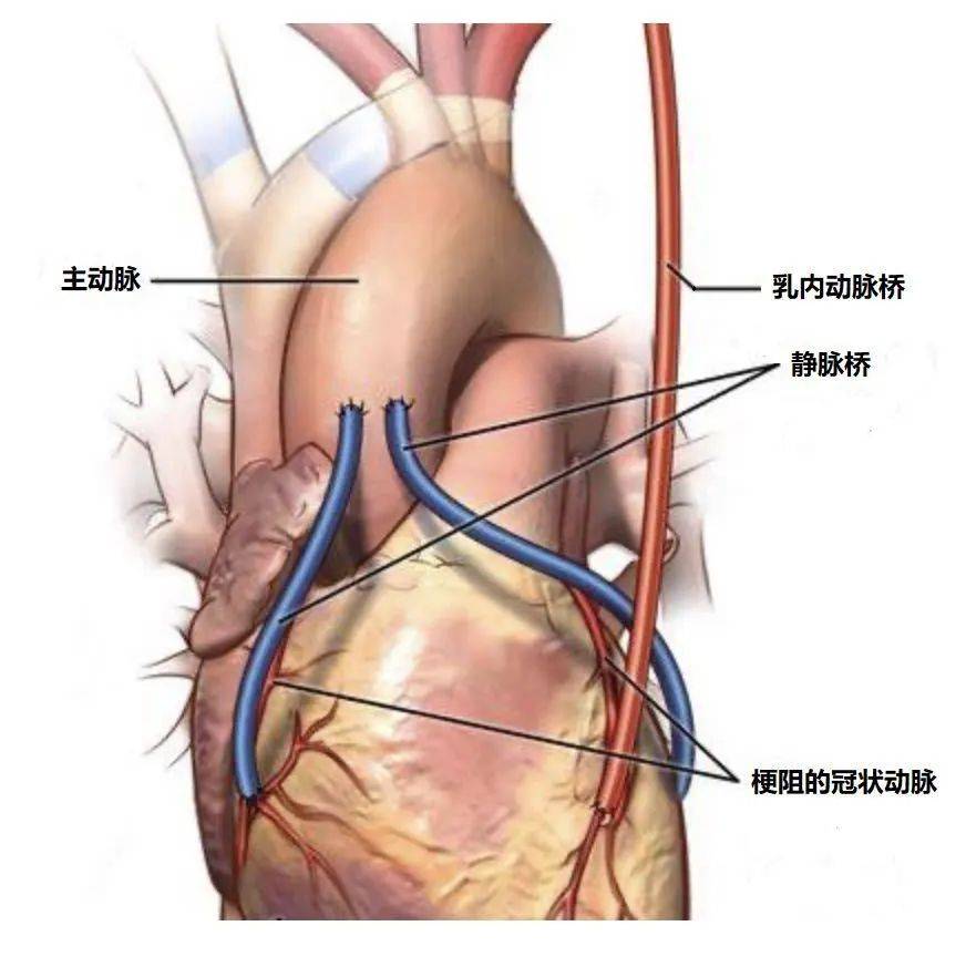红色的桥血管是乳内动脉到前降支的桥 蓝色的是静脉桥,搭在回旋支和