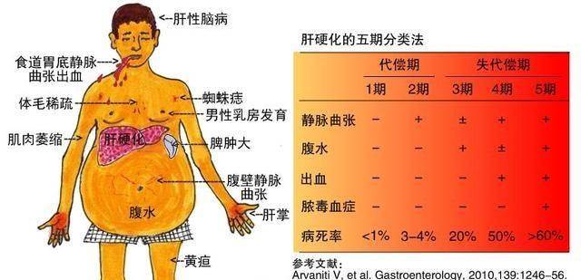 身上小红点——蜘蛛痣;膨大的肚子——肝腹水;见到医生,连检查都没做