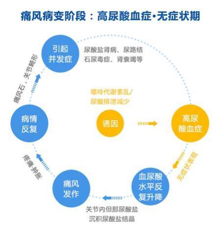 济南中医风湿病医院免疫吸附血液净化疗法治疗痛风