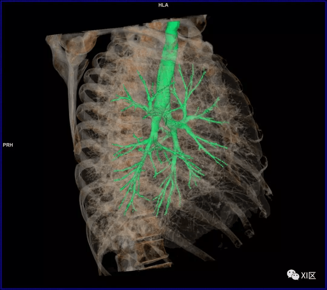 如此详细的肺部影像解剖,有点儿酷!_气管