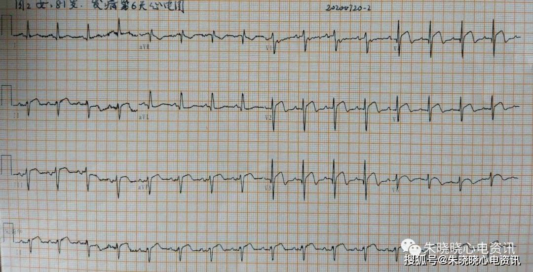 卢老师看心电图 高龄重症心肌炎心电图演变 2020-7-20
