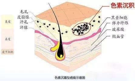 起了晒斑怎么办