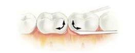 牙齿被虫蛀了怎么办