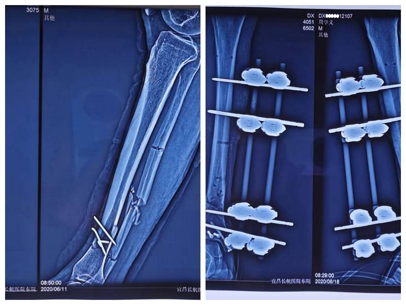 宜昌长航东院:胫骨遭车祸粉碎 东院巧手术还原
