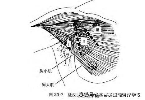 目前,通常以胸小肌为标志将腋区淋巴结分为三组(图23-2 i组:胸小肌