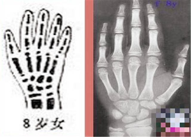 孩子|否则多半是小矮个女生初潮来临后会停止长个?不要早于此年龄