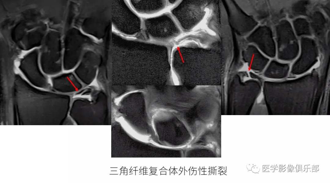 尺骨撞击综合征影像表现_三角