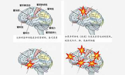 怀孕期间癫痫病发作怎么办_手机搜狐网