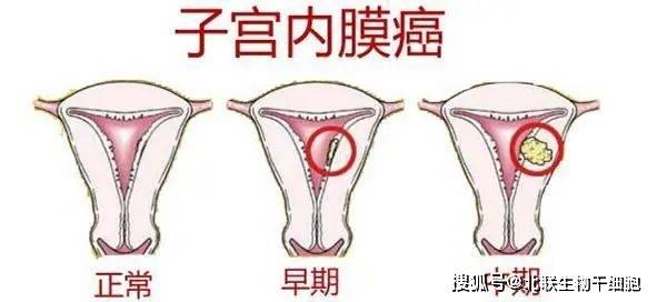 月经失调,离子宫内膜癌到底有多远?