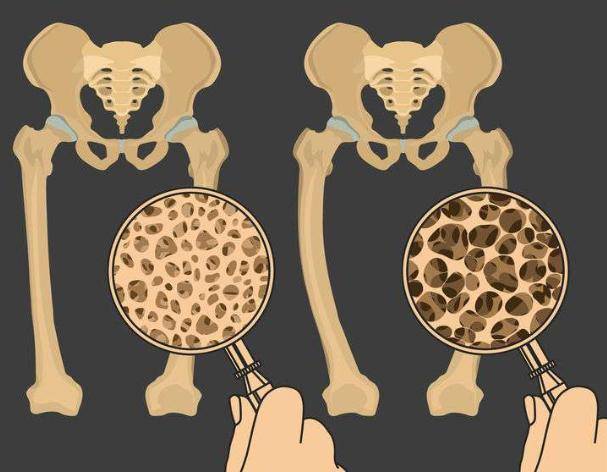 骨质疏松多少严重 9b7edafe2beb4633873c9c2eb4424652.jpeg