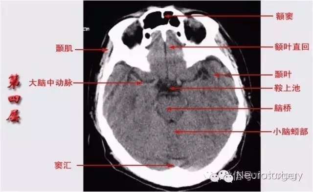 初学者必备:颅脑ct解剖口诀及彩色解剖图