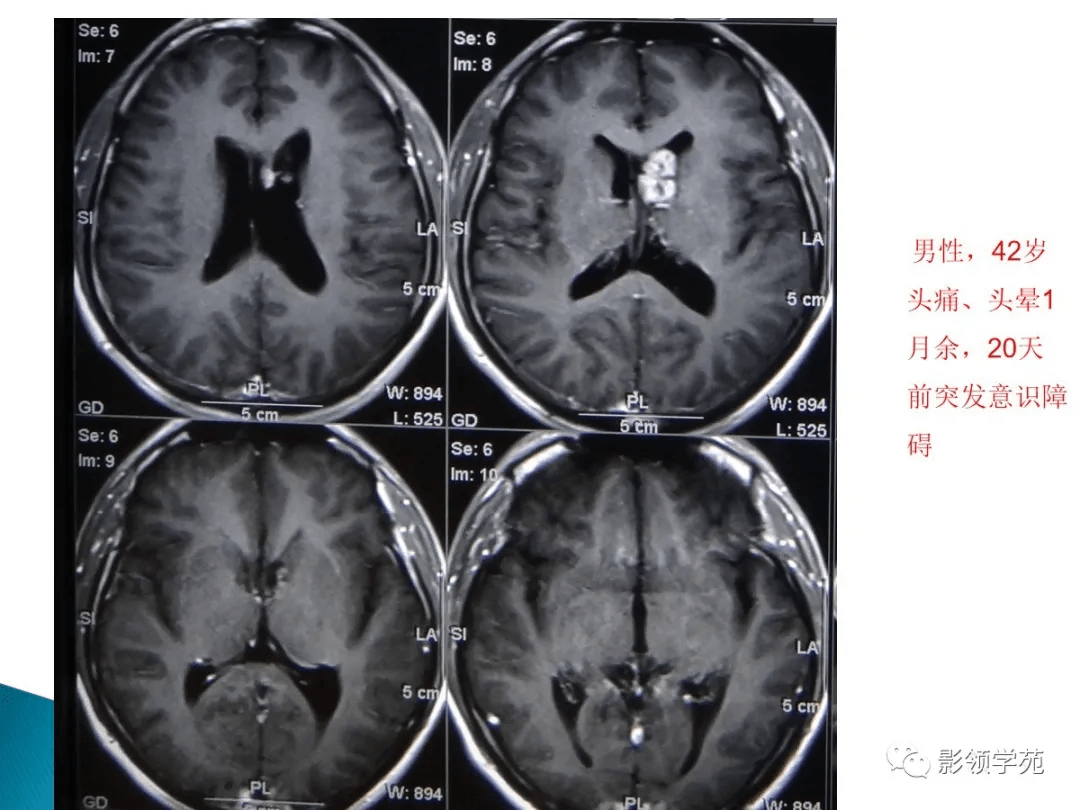 什么是高密度结节 9436eb2afcc344e7b3ab2c5765e5ca37.png