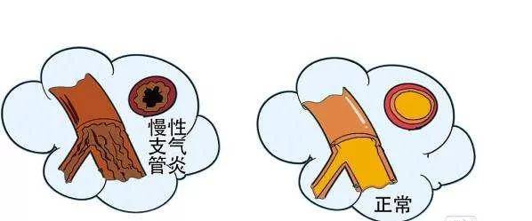 大人久咳不愈怎么办