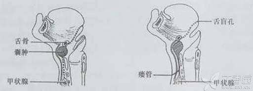 甲状舌管囊肿的临床表现