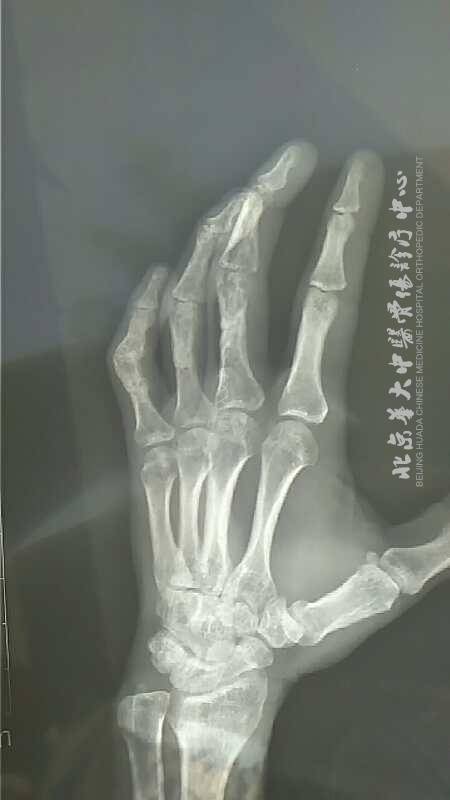 手指骨骨折治疗案例-五个月未愈合患者治疗效果分析