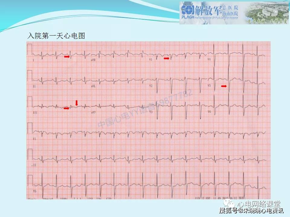 肺栓塞心电图表现及鉴别诊断
