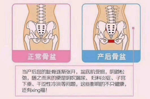 产后盆骨修复,最便宜都要2000多,是"智商税",还是真有效果?