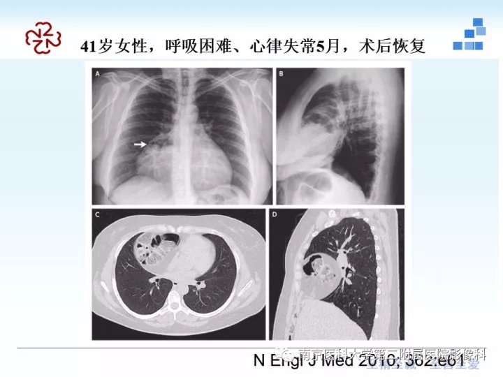 膈肌的解剖及常见病变影像表现