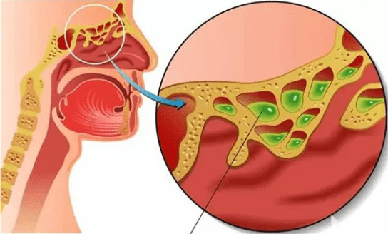 【清鼻堂】头痛反复发作,原来"鼻窦炎"才是元凶!