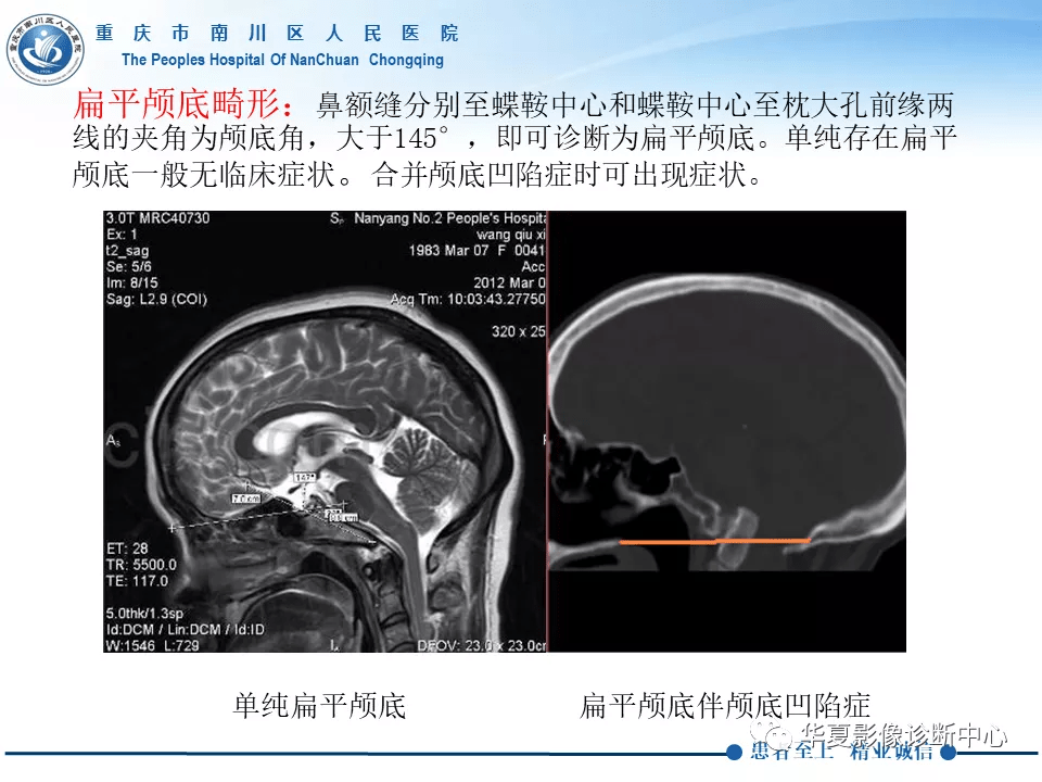 颅底凹陷症合并脊髓空洞病例分析