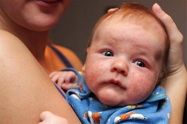 宝宝|红屁股、湿疹极易找上门来，你找到护理关键了吗宝宝皮肤娇嫩