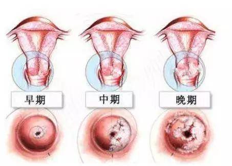 妇产科医生谈宫颈癌筛查tct和hpv怎么选