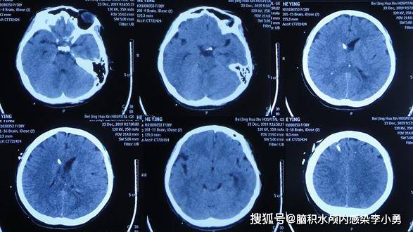 38岁女性脑出血2次双侧脑室外引流术后并发脑积水颅内感染,现在一切正常