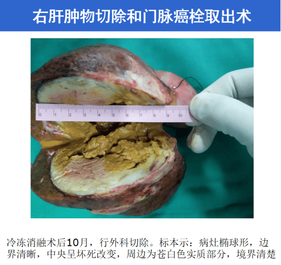 原创福州国德医院肿瘤科案例:鸡尾酒疗法治疗晚期肝癌
