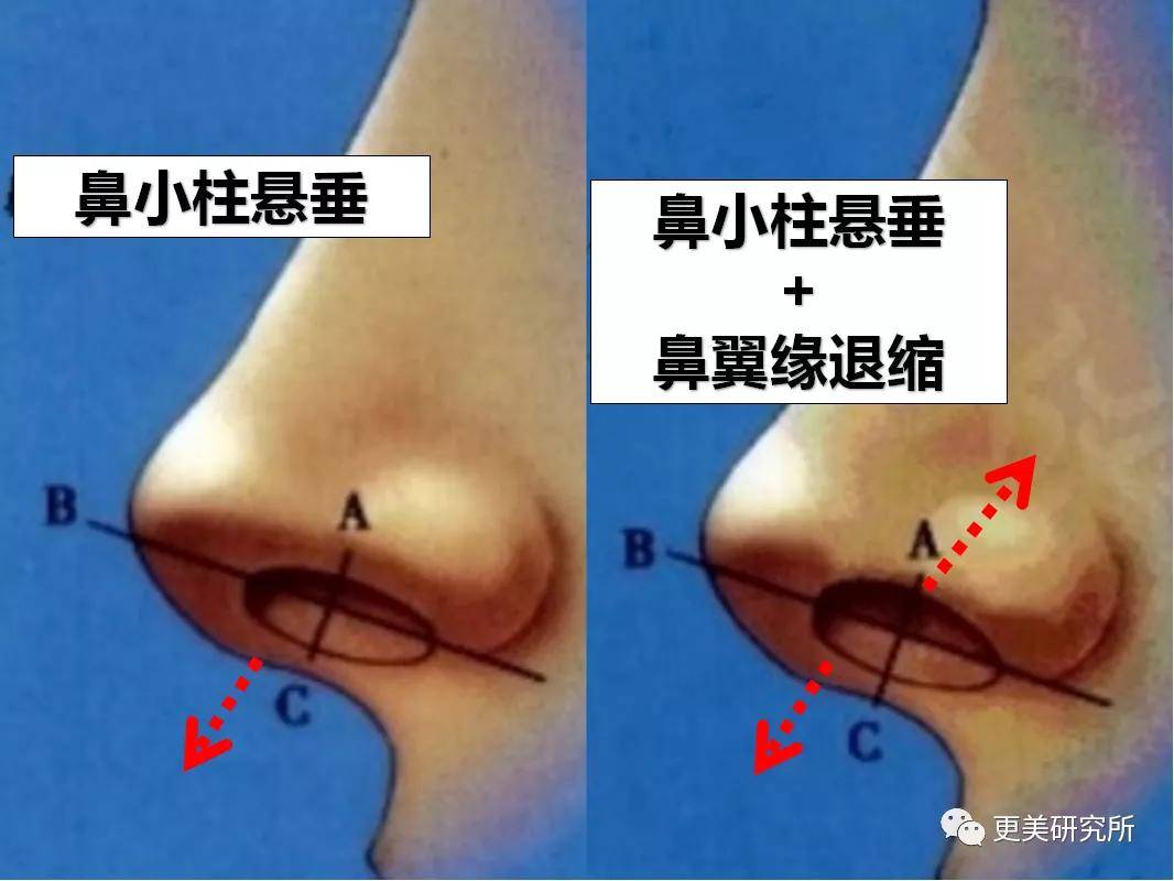 鼻尖|杨幂终于去修复鼻子了…