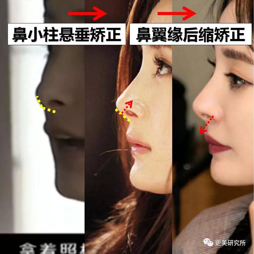 鼻尖|杨幂终于去修复鼻子了…