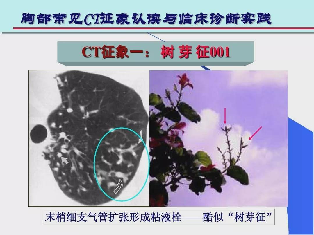 由终末细支气管和肺泡腔内病变形成的小结节影与分支细线影构成的