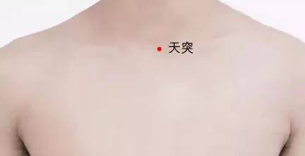 天突穴阿是穴(甲状腺肿大处:艾灸病灶部位促使其软化,缩小.