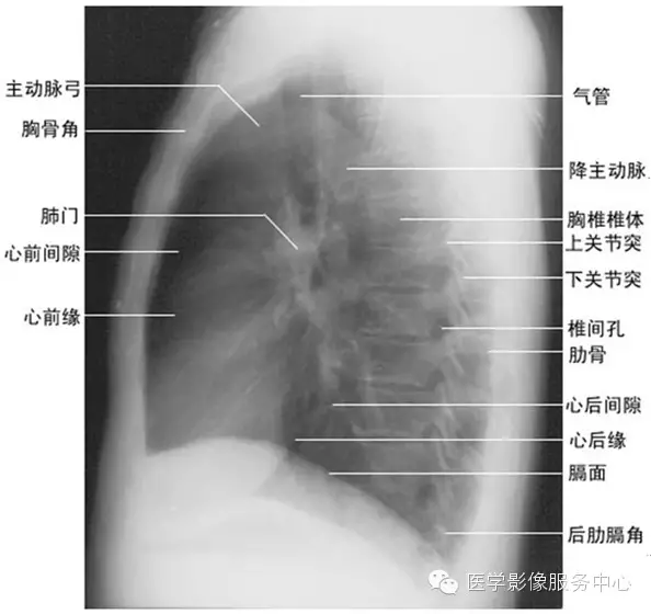 8.心影后:在投照条件较底的胸片,病灶易漏诊,要注意对侧位的观察