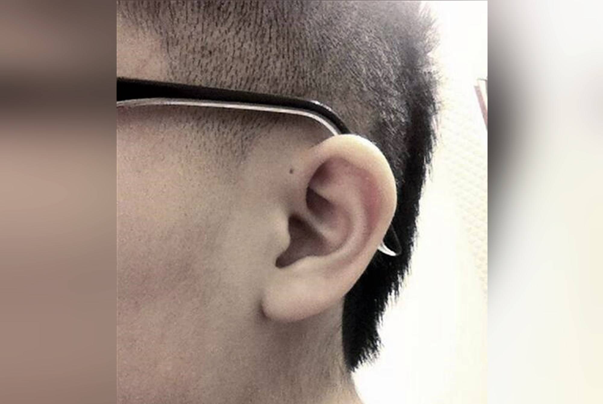 耳朵|可能暗示孩子危险为啥有些新生儿耳朵上有“小孔”？不是聪明孔