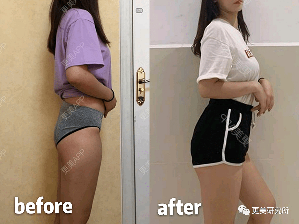 脂肪|鞠婧祎再花70w能do成迪丽热巴的前凸后翘？！