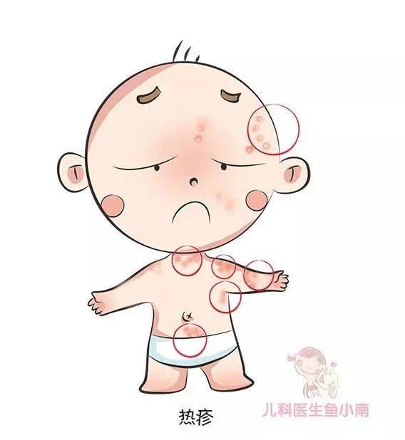 皮肤|医生：首先你必须要分清皮疹湿疹热疹这3种宝宝皮肤问题总反复