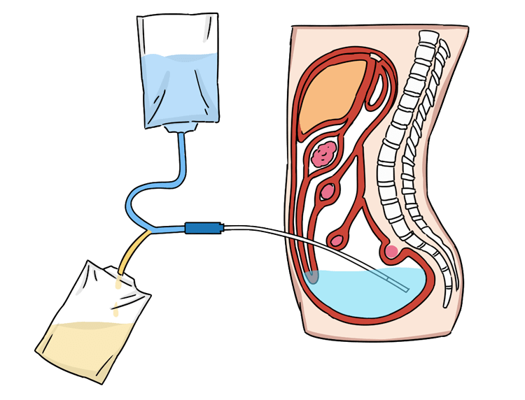 食物|「尿毒症」越来越多，医生提醒：少吃这些食物，肾病不敢找你麻烦