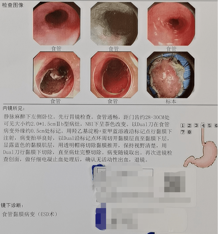 胸部不适居然是早期食管癌这些习惯要不得