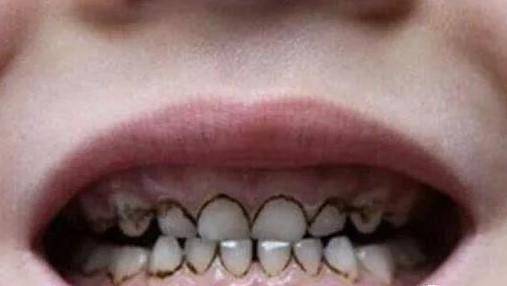 孩子牙齿上黑色的东西都不是蛀牙那是什么能治吗怎么治