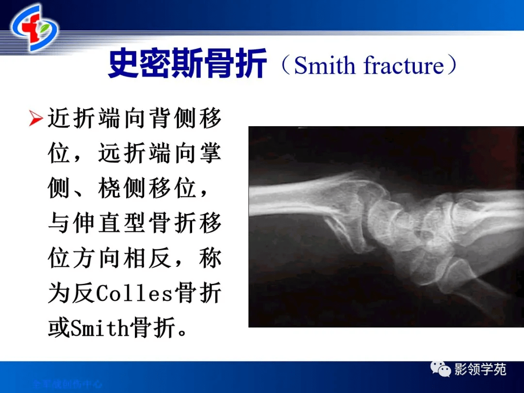 10种上肢骨折的影像学表现