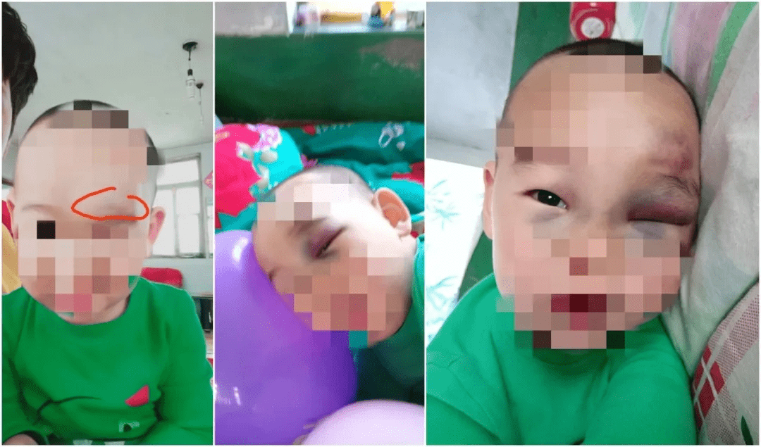 孩子眼眶磕肿了怎么办