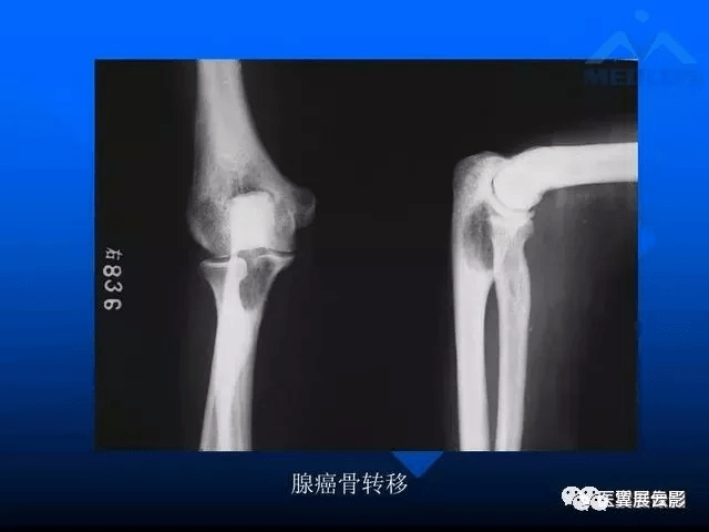 12种关节周围囊状骨破坏的诊断与鉴别