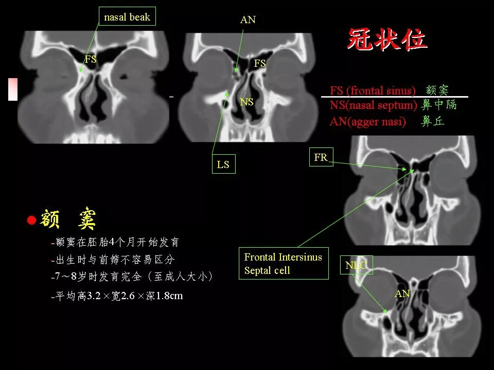 鼻腔,鼻窦的ct解剖及该区域常见疾病的影像学诊断