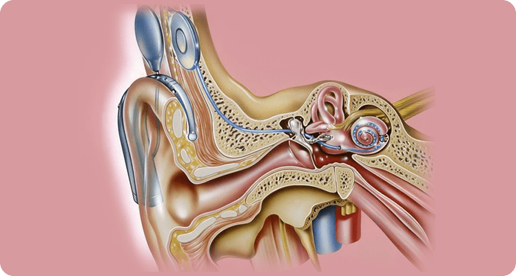 耳聋患者究竟该选择人工耳蜗还是助听器?