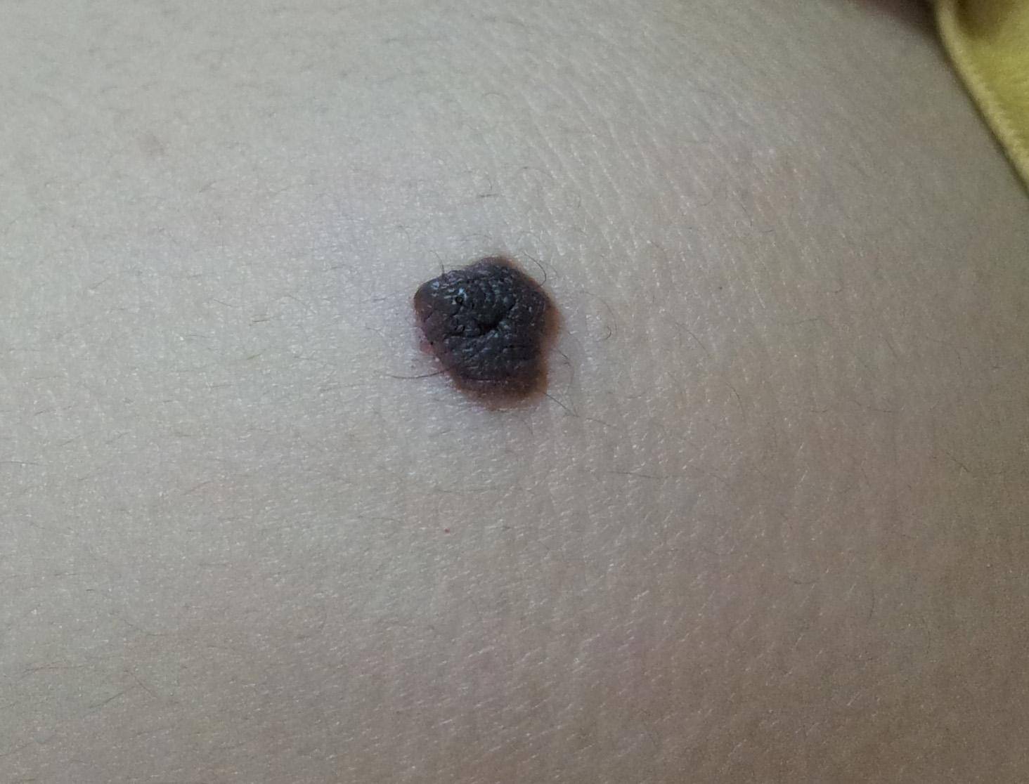 什么是黑色素痣 3c91297010074c5d8a105547a28cefed.jpeg