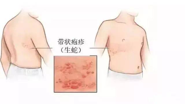 射频治疗带状疱疹性神经痛
