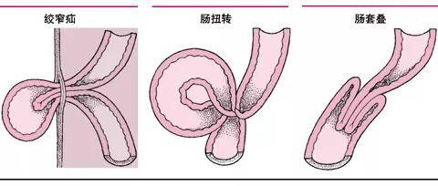 警惕肠梗阻的“致命一阻”