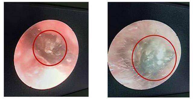 贵阳铭仁耳鼻喉医院25岁女子国庆后险失聪竟是外耳道肉芽作怪