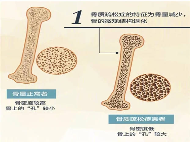 艳阳天|秋日艳阳天 健骨正当时——骨质疏松症的中医防治