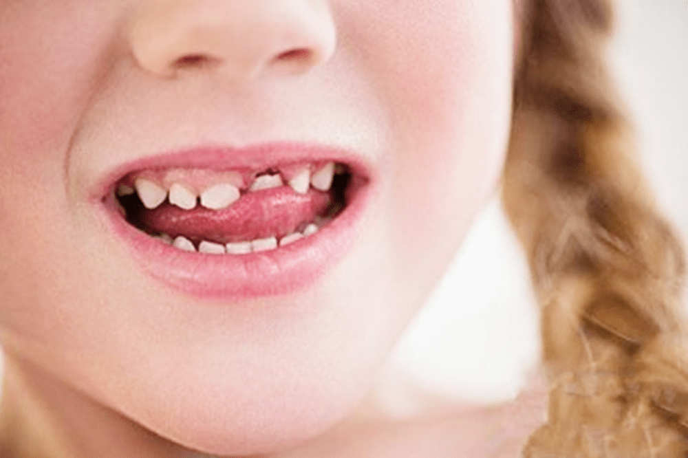 孩子换牙后牙齿越长越"歪",到底是谁的锅?可能这些家长没做好